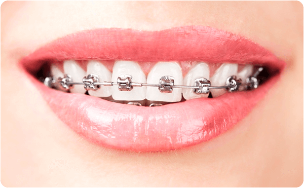 Vale a pena investir no aparelho autoligado? - Radio Memory