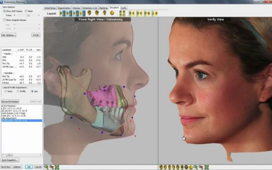 Fig 2 – planejamento de movimentação óssea para cirurgia ortognática unindo tomografia e escaneamento facial. 